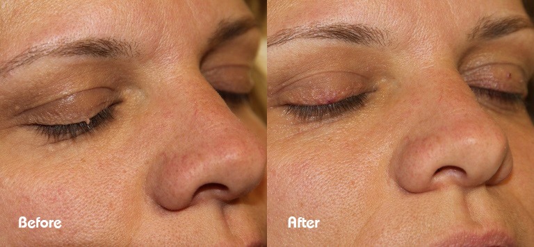 Skin tag near eye before and after cryotherapy — Beau Synergy Ltd